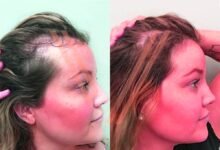 hair transplant in Turkey