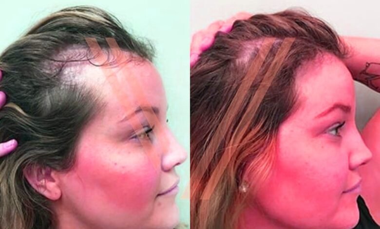 hair transplant in Turkey